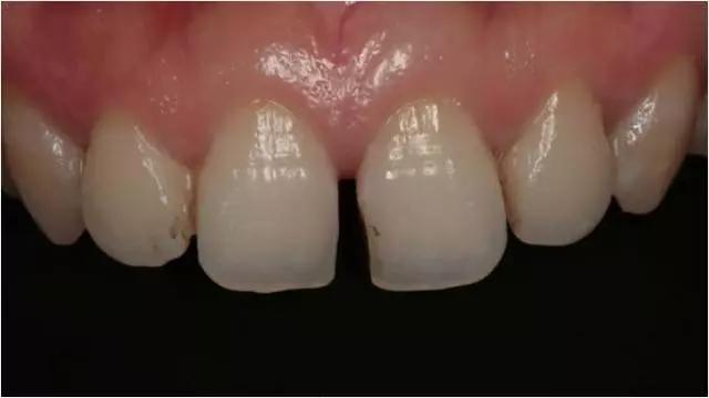 四十多岁门牙缝隙越来越大怎么办,儿童门牙缝隙越来越大原因