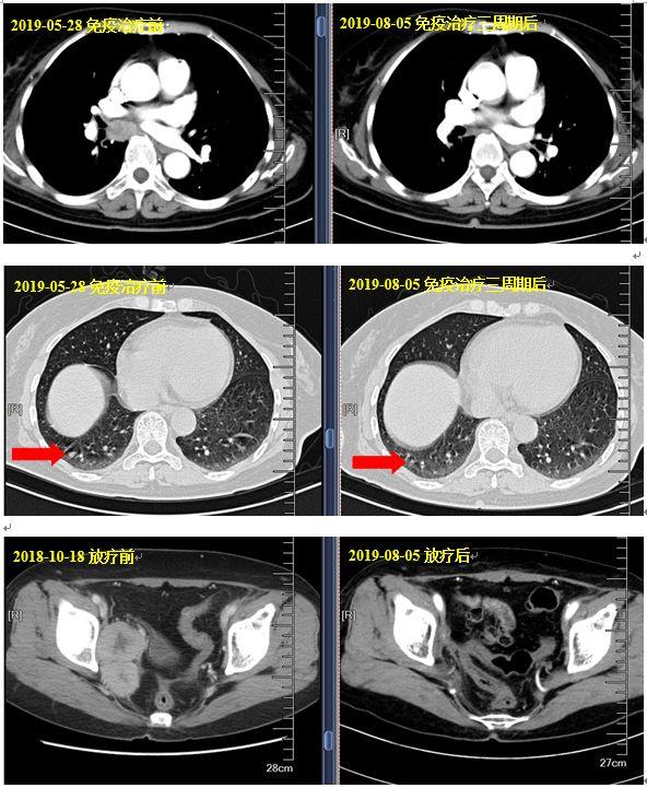 宫颈鳞状细胞癌抗原1.6,宫颈鳞状细胞癌抗原1.8确诊宫颈癌