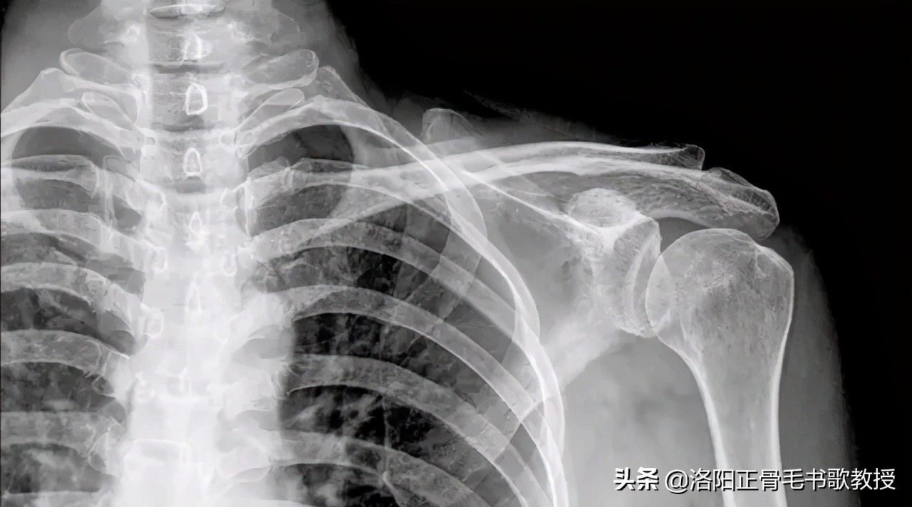 肩周炎不能梳头发怎么办,肩周炎梳头发困难怎么锻炼视频