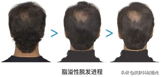 脱发不可挽救吗,脱发没有根治办法吗