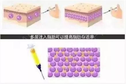 自体脂肪丰唇需要哪些准备,自体脂肪填充术前准备