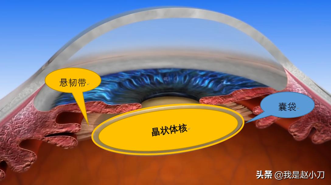 什么手术对白内障最好,老人家最先进的白内障手术过程