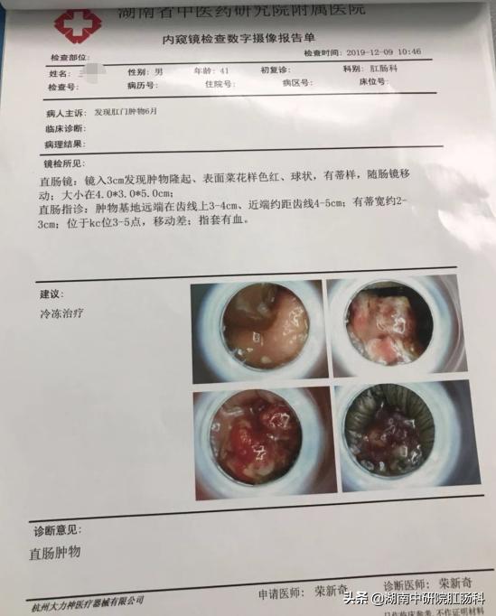 低位直肠癌早期能保肛吗,低位直肠癌晚期治愈吗