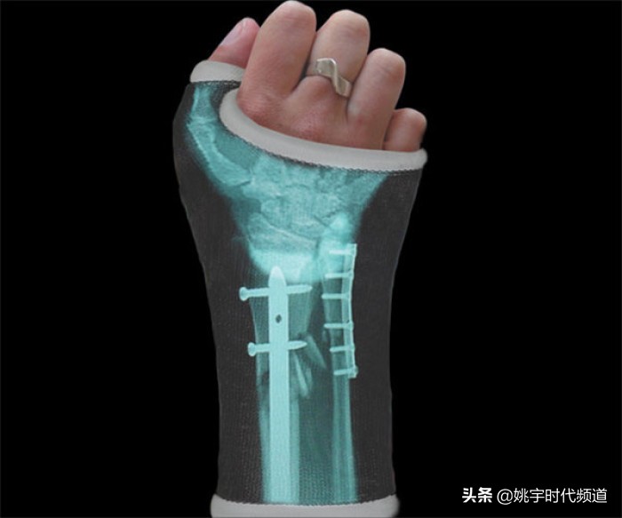 骨折做完手术注意哪些事项,骨折以后做手术以后需要注意什么