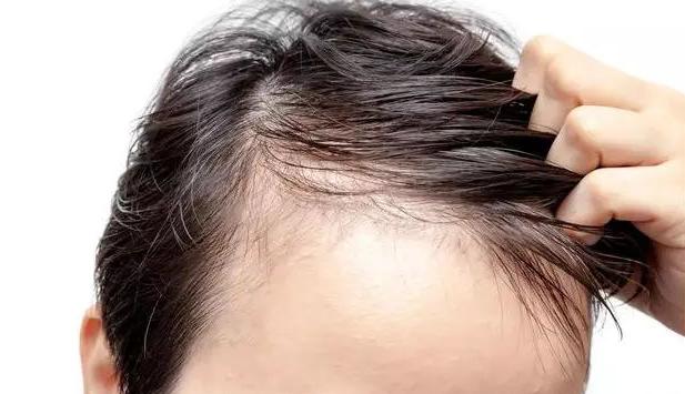 贝克汉姆脱发,贝克汉姆被曝脱发角度问题