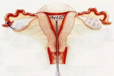 试管婴儿为什么还需要着床,试管婴儿为什么要做