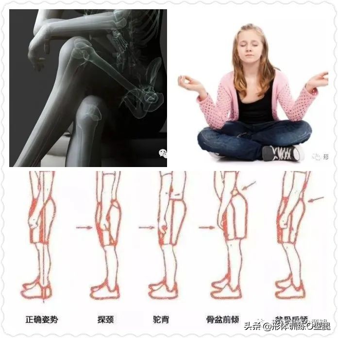 o型腿和罗圈腿图片对比,o型腿和罗圈腿的区别
