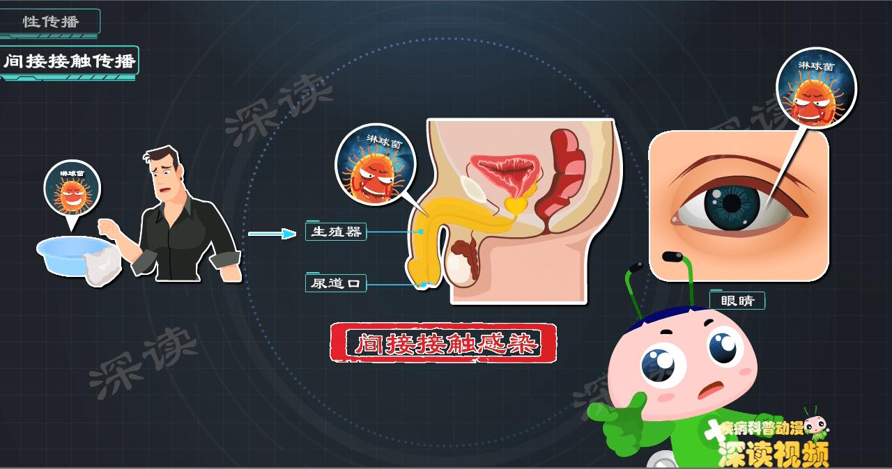 女性如何知晓得了淋病,女的有淋病一次就能中招吗