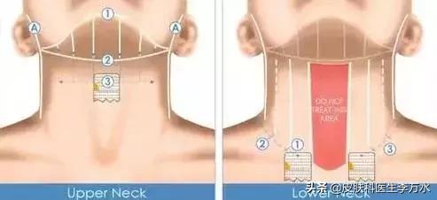 张雨绮说超声刀就像在烤肉?!线雕和超声刀,究竟哪个更靠谱?