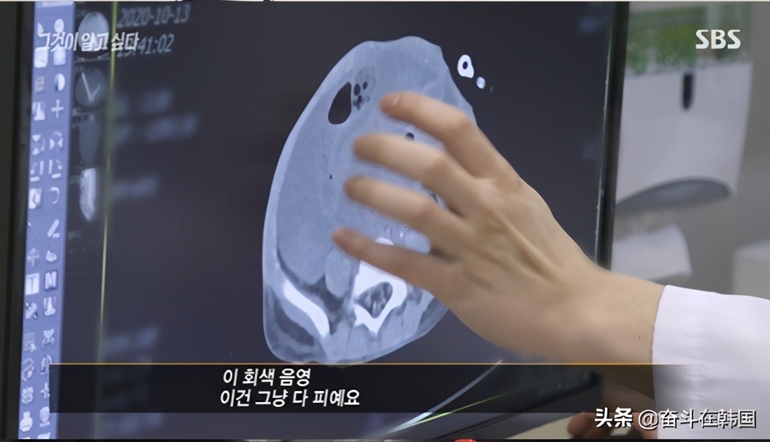 内脏破裂重伤,18个月韩国小孩内脏破裂死亡