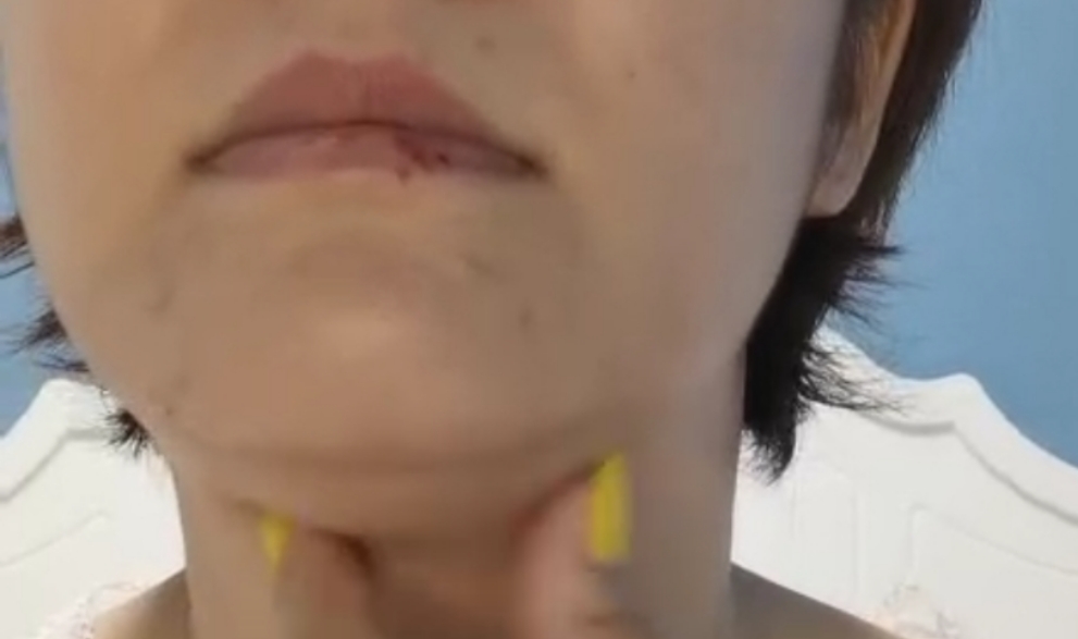 治疗一例咽痛如刀割状、牙痛、唇部疱疹者，一副药未尽剂而愈。