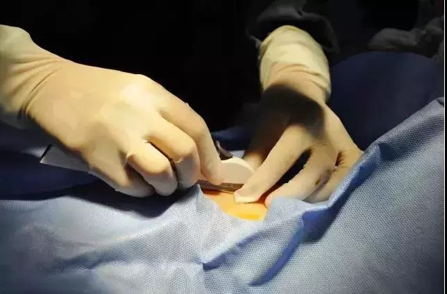 小小一根棒，比套套和上环安全，避孕率超高却少有人知道...