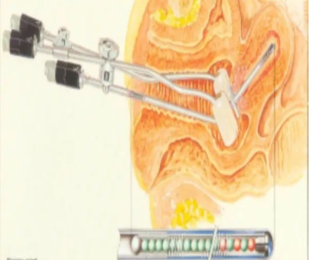 近距离放疗的副作用,近距离放疗