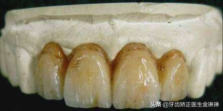 淄博的水氟斑牙,内蒙古氟斑牙是怎样形成的