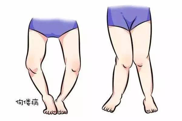 孩子佝偻病的表现怎么治疗,为什么小孩缺钙会得佝偻病