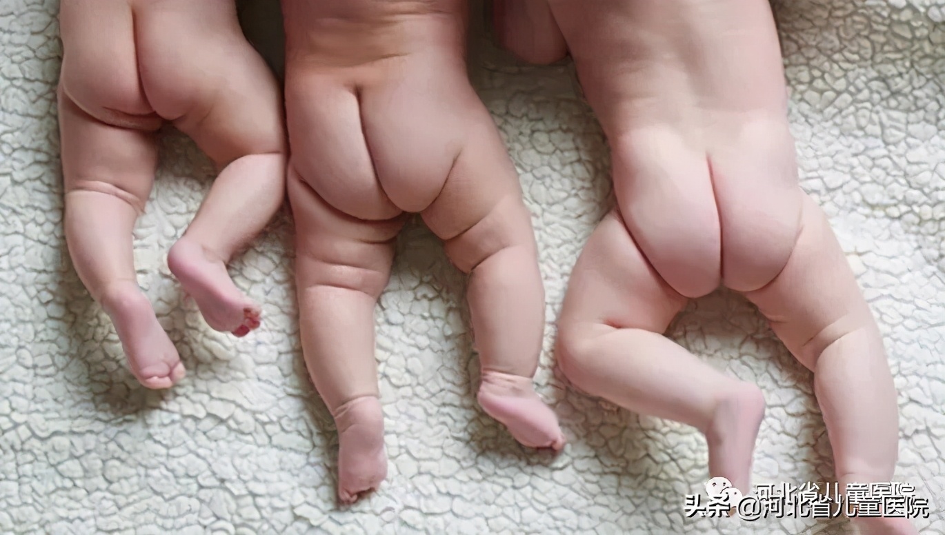 腿纹不对称家长千万别忽视,腿纹深浅不一样算不对称吗