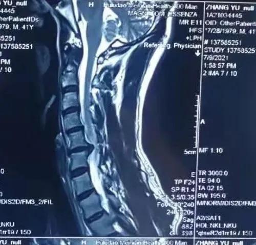 成功开展“钥匙孔”技术治疗颈椎病