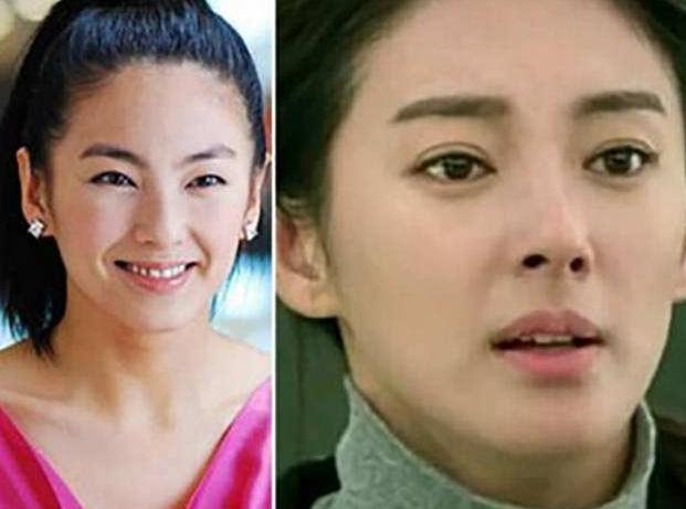 割双眼皮是种什么体验,割双眼皮什么样子才是增生