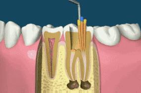 根管治疗后牙裂了还可以做牙冠吗,根管治疗后戴牙冠有什么利弊