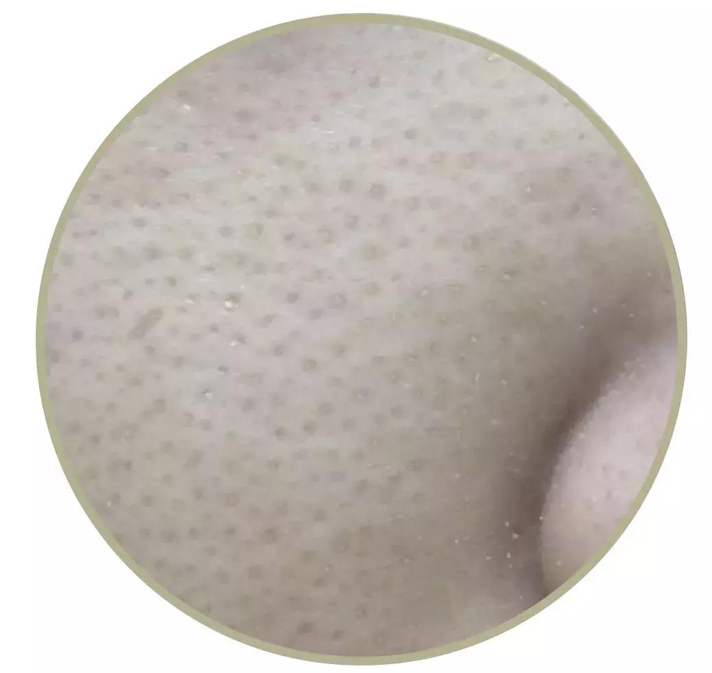 毛孔粗大后背长痘怎么办,女生后背毛孔粗大怎么办