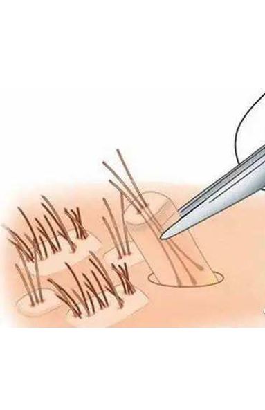 头发种植是怎么操作的,头发种植利弊有哪些呢