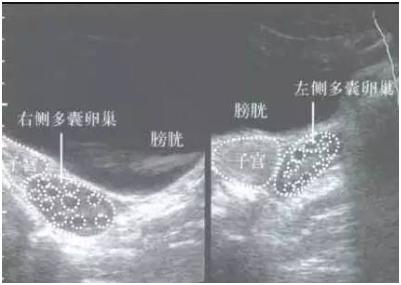 聊聊多囊卵巢综合征的那些事,聊聊不一样的多囊卵巢综合征