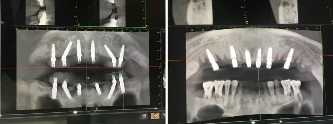 日照口腔医院种牙价目表,日照口腔医院种植牙价目表