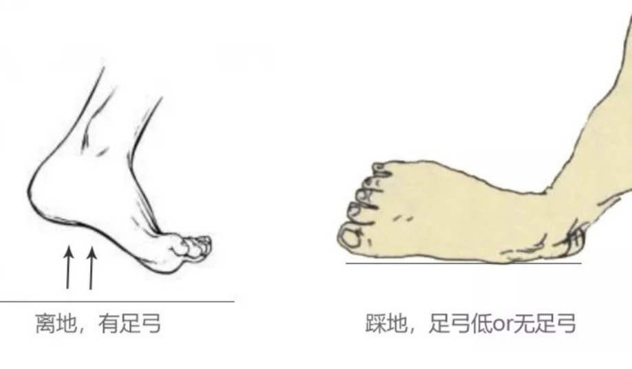 扁平足治疗手术费用,扁平足儿童专用鞋