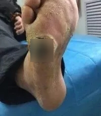 糖尿病脚底疼是不是并发症,糖尿病并发症脚底脱皮严重