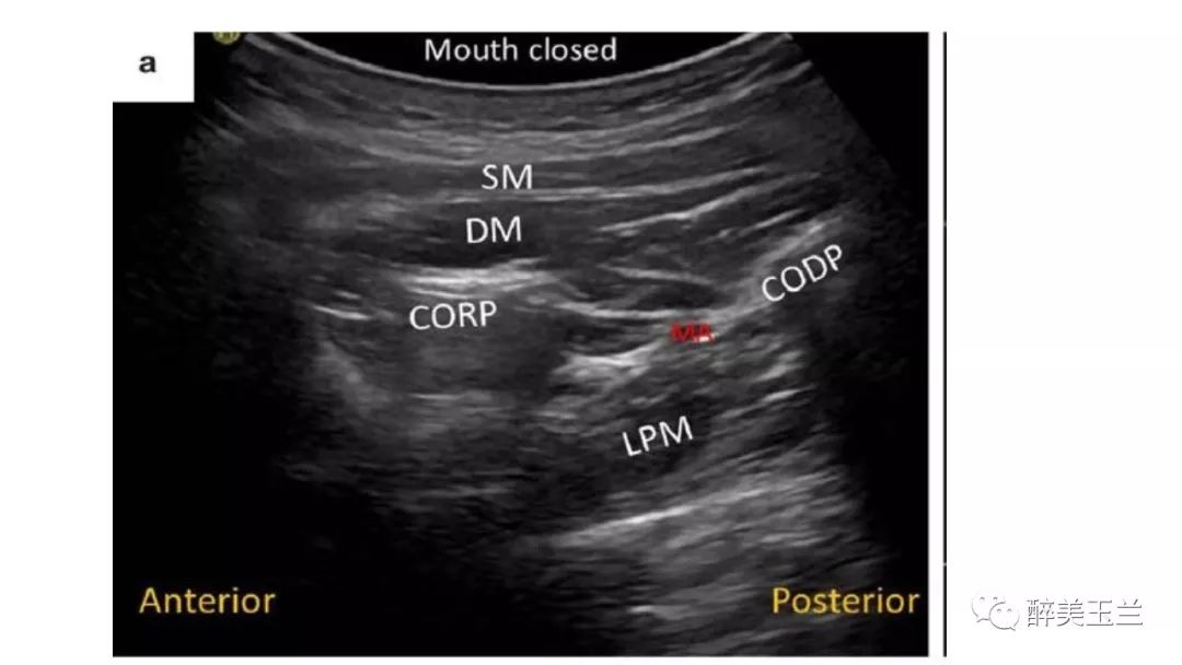 病例分享丨三叉神经节微球囊压迫术的麻醉管理