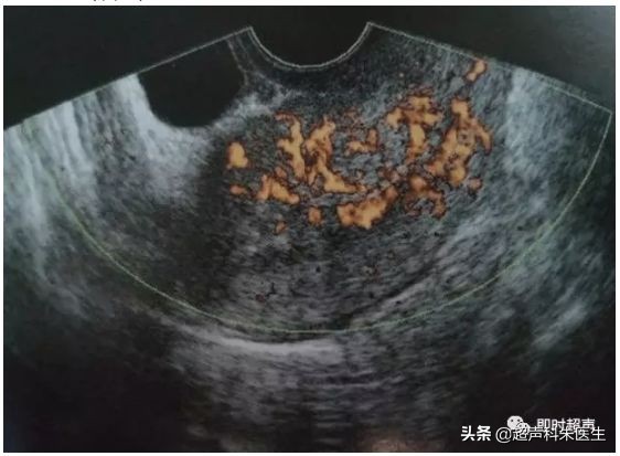 妇科超声的标准超声图,妇科超声图解
