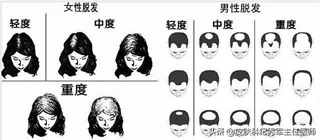 雄激素脱发中医治疗,雄激素脱发有恢复案例么