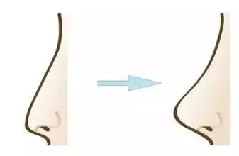 隆鼻能坚持到老吗,隆鼻的潜规则有哪些