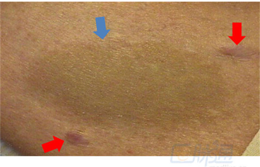 全身内外都是瘤子是什么病,全身长满瘤子怎么治疗