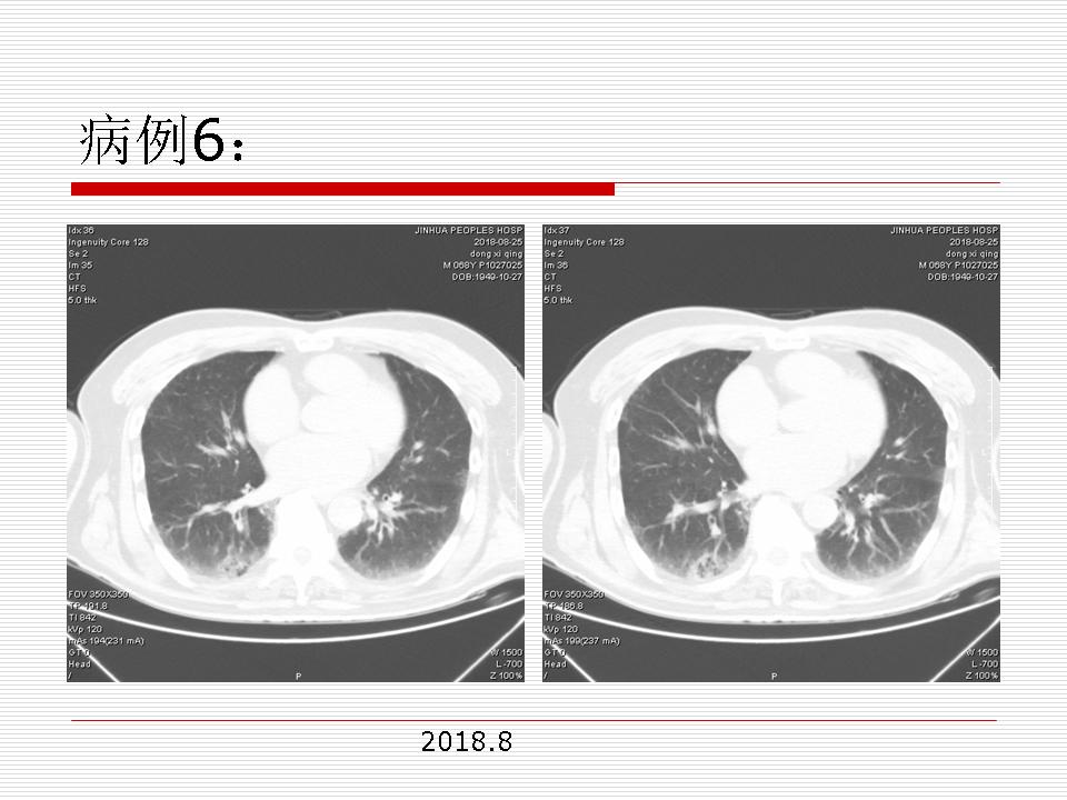 像炎症的肺癌能治好吗,医生说可能是肺癌也可能是炎症