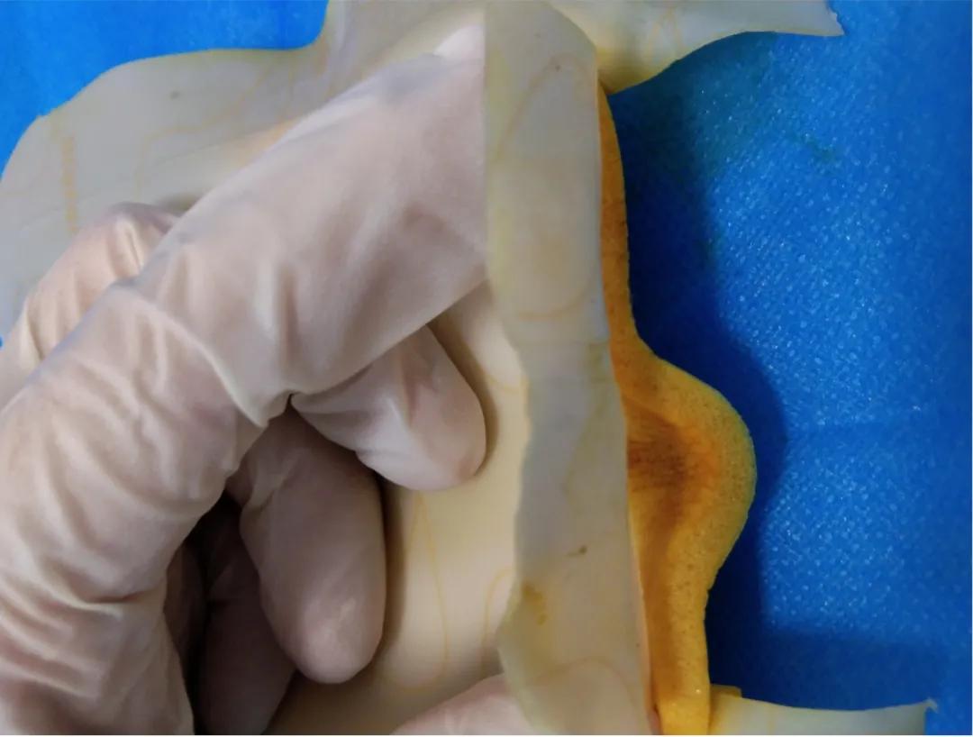 拜尔坦泡沫敷料能促进伤口愈合吗,什么样的病人应该用泡沫敷料