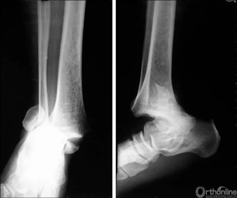 骨折闭合复位髓内钉内固定术,骨折闭合复位