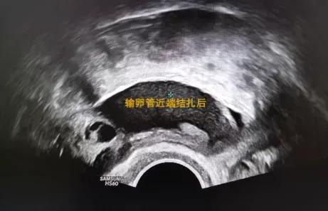 输卵管积水做宫腔镜能处理吗,输卵管积水做腹腔镜主要怎么处理