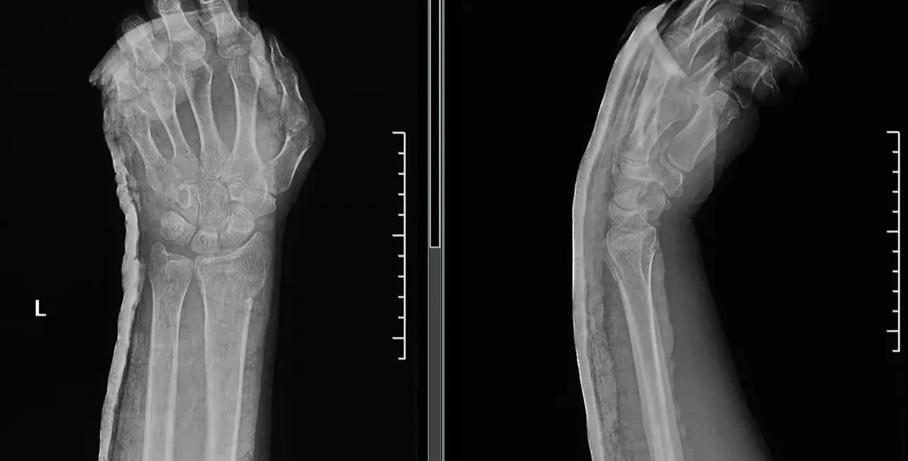 骨折复位后又移位有什么症状,骨折手法复位后容易移位吗
