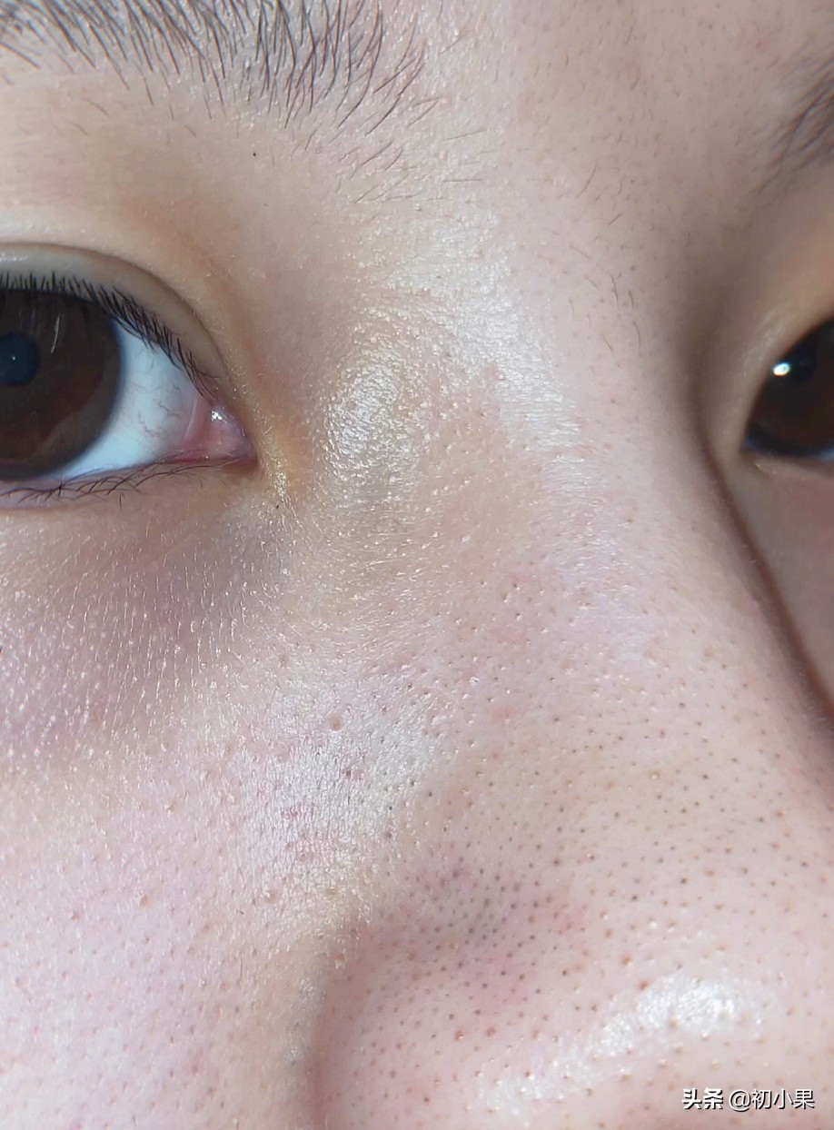 鼻子上的黑头怎么去除,鼻子上的黑头怎么去除小孩
