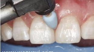 门牙缝可以补吗,为什么门牙有缝