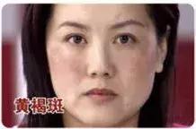 皮肤长斑有民间小方法祛斑吗,教你几招简单祛斑小方法