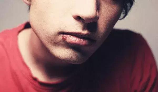 冬季烂嘴角是怎么回事,烂嘴角是因为上火吗