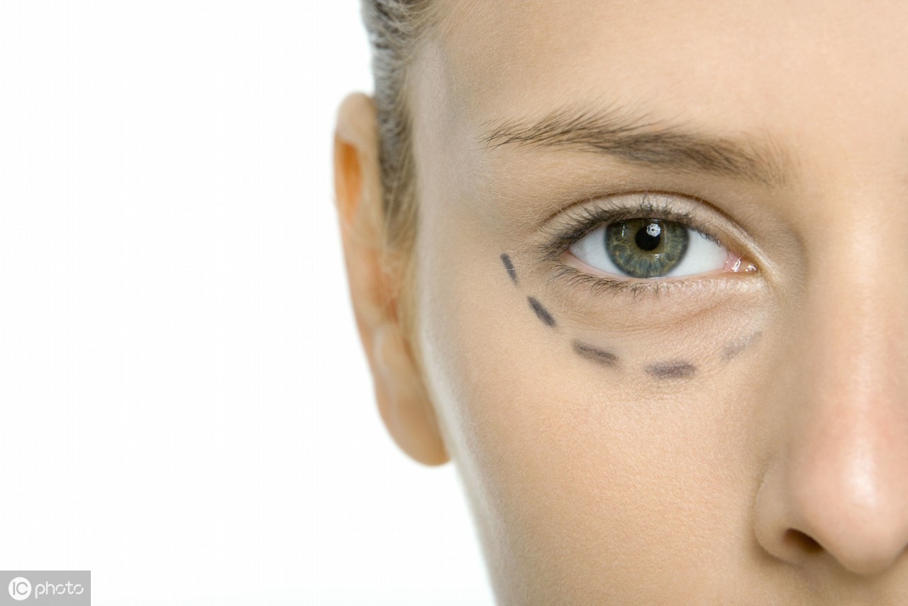 双眼皮手术后拆线遗留线头,做双眼皮手术后分叉怎么办