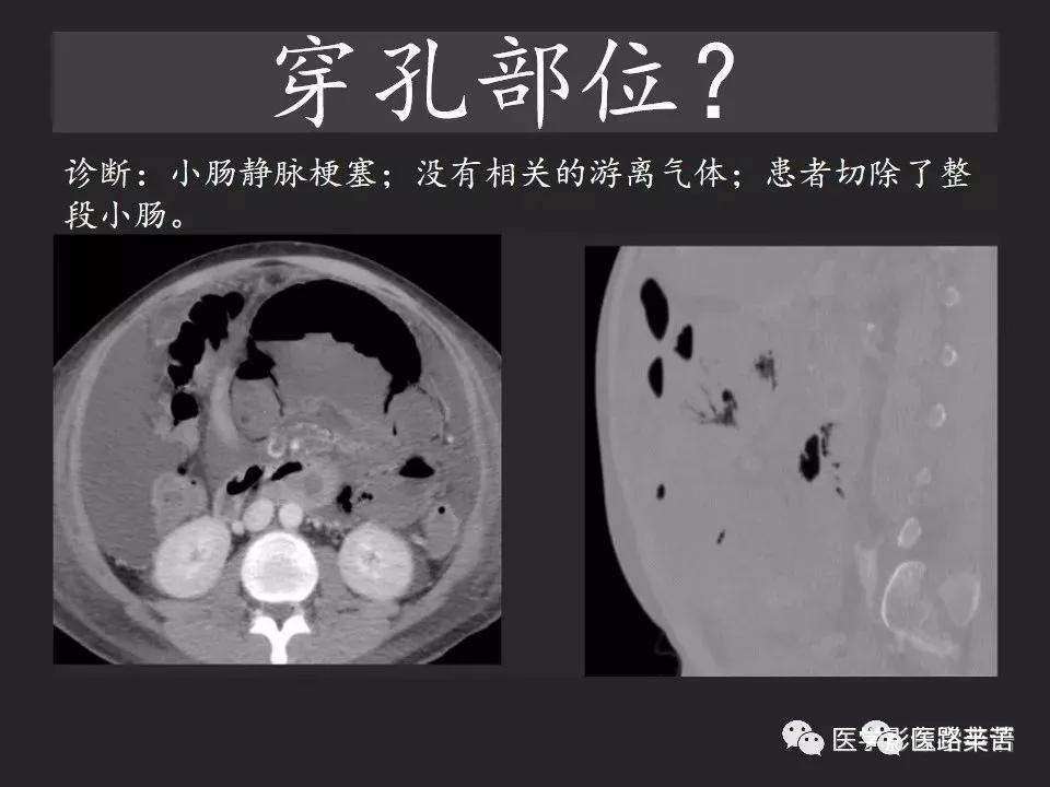 空腔脏器穿孔和胃肠道穿孔区别,腹膜后穿孔一般是哪里穿孔