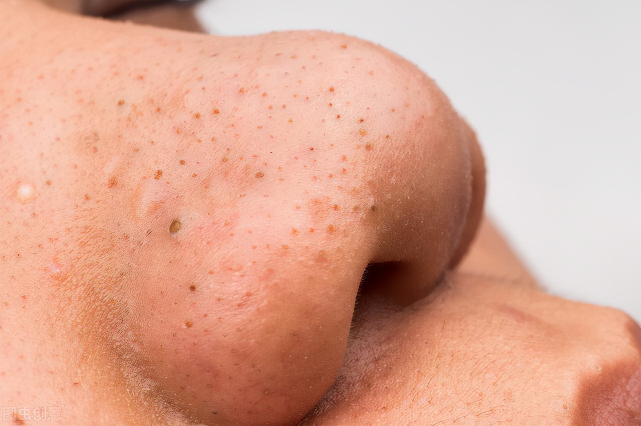 怎么去黑头最有效而且还不反复,如何简单去黑头最有效的方法