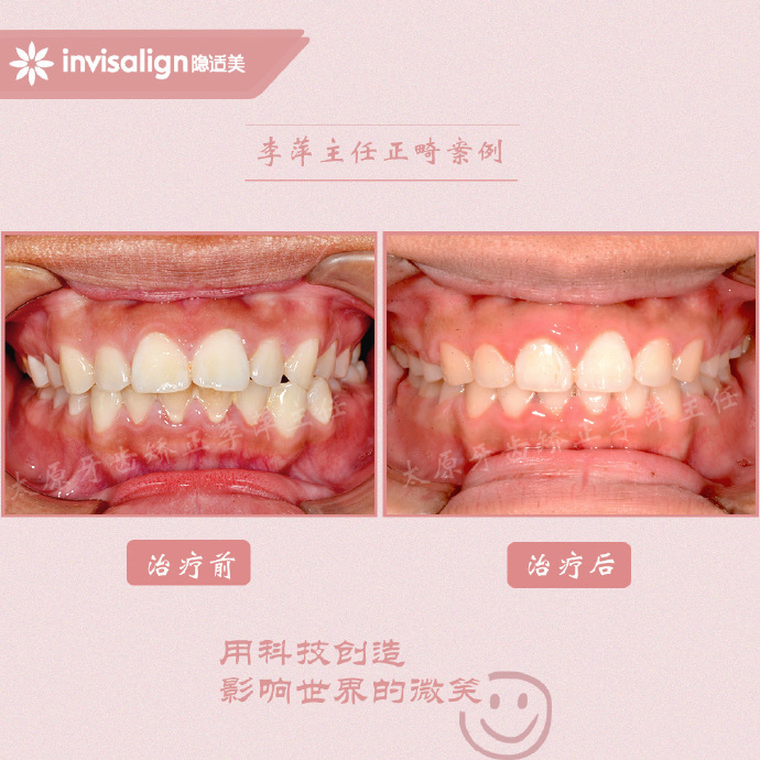 龅牙矫正牙齿能解决下颌后缩么,儿童正畸能解决鼻基底凹陷问题吗