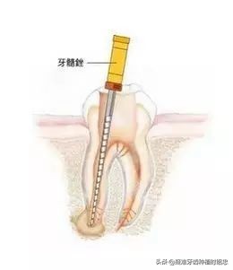 根管不通是怎么导致的,根管不通是怎么回事