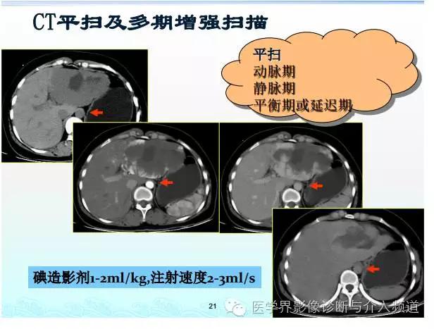 增强ct碘过敏该用什么造影剂,加强ct造影剂过敏皮疹多久能恢复
