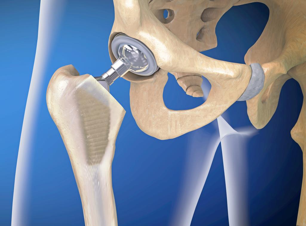 股骨头坏死到底是怎么回事啊,股骨头坏死究竟能不能治好